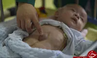 نوزاد سر راهی با قلبی خارج از سینه