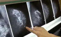 تشخیص سرطان پستان پنج سال زودتر از ابتلا!