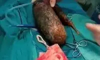 پزشکان ۷کیلو مو از شکم دختر هندی خارج کردند