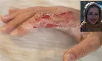 امکان بهبود ترمیم پوست پس از سوختگی شدید