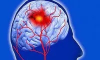 ردیابی ویروس ایدز در مغز به وسیله ام آر آی