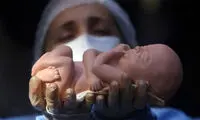 سالیانه؛ ۳۰۰ تا ۵۰۰هزار سقط جنین در ایران