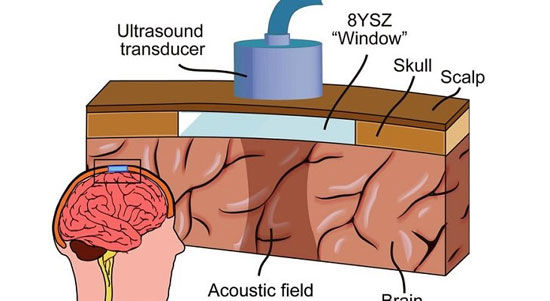 درمان آلزایمر و پارکینسون با جراحی مافوق صوت