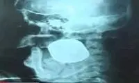 نارنجک از صورت یک زن خارج شد!