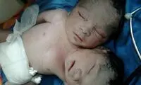 عکس: تولد نوزادي با دو سر در دزفول