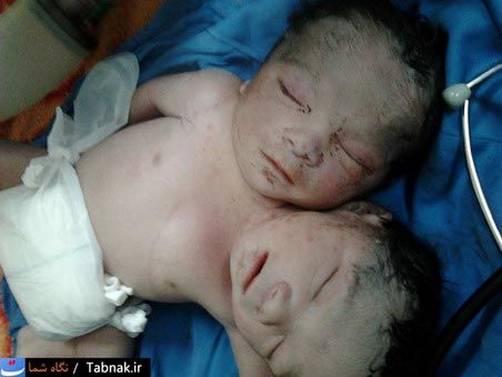 عکس: تولد نوزادي با دو سر در دزفول