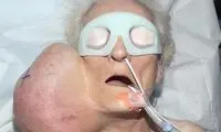 توموری وحشتناک در گردن این زن (16+)