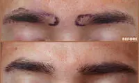 بهترین کلینیک کاشت ابرو در کرج + معرفی 10 کلینیک برتر