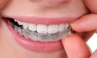 ارتودنسی بدون سیم چیست؟ | هزینه، مزایا، معایب ارتودنسی نامرئی
