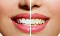 با این روش خانگی سفیدترین دندان‌ را داشته باشید