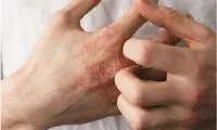 ۶ راهکار برای جلوگیری از خشکی پوست