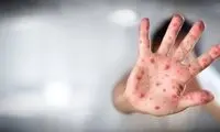 تصویر دلهره‌آور از ورود آبله میمونی به ایران
