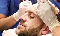 موهای کاشته شده از کی طبیعی به نظر می‌رسند؟ زمان‌بندی رشد و تغییرات
