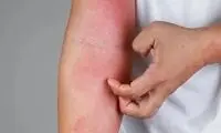 چگونه از شر خارش و التهاب در فصل بهار رها شویم؟