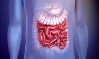 ۵ ماده غذایی که برای سلامت روده ضرر دارند