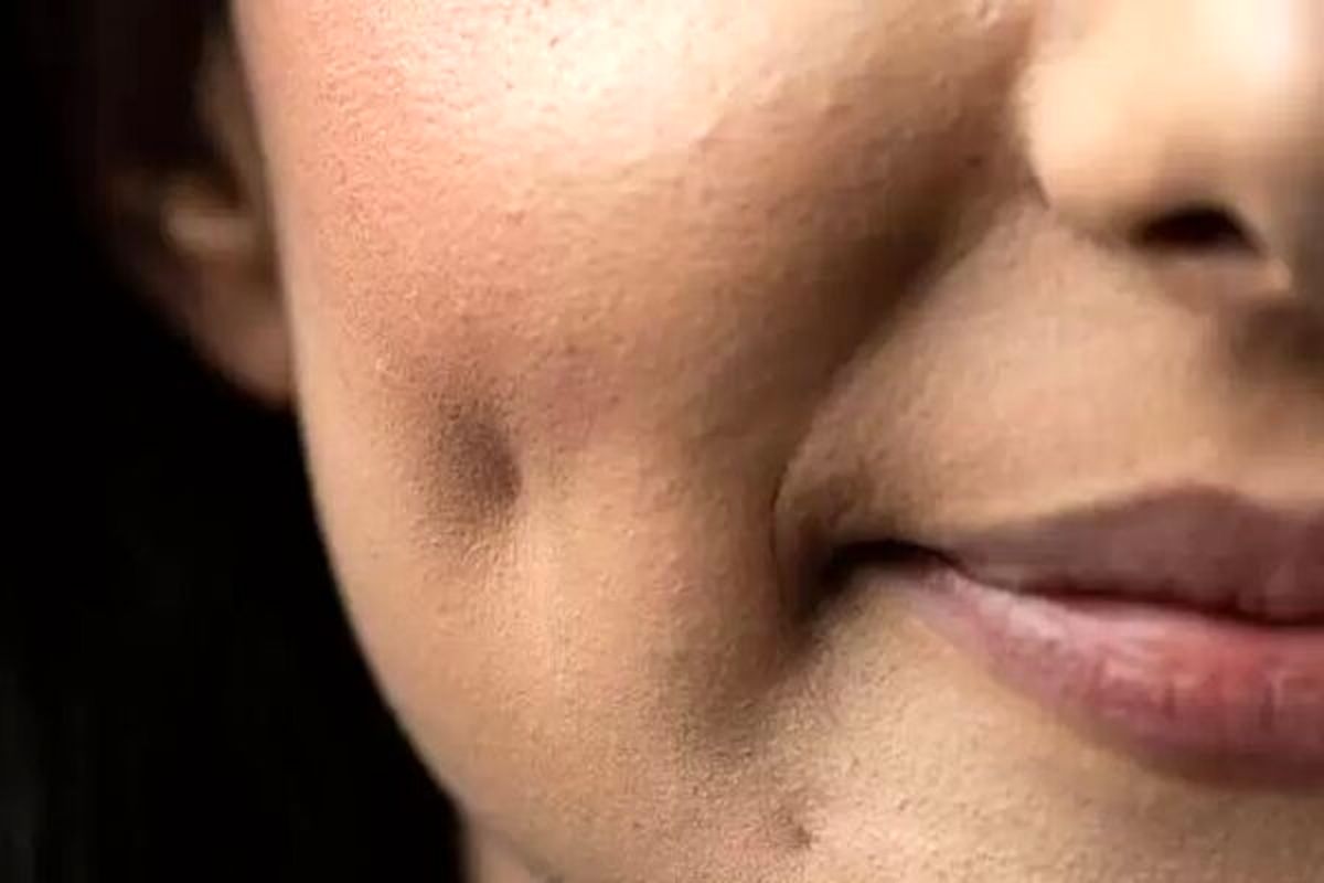 جراحی چالگونه و خطرات جبرانناپذیر آن