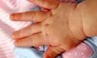 تصویری از نوزاد عجیب‌الخلقه با بدن هشت پا