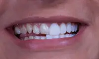 لمینت دندان جلو چگونه انجام می‌شود و چه مزایایی دارد؟