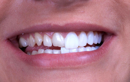 لمینت دندان جلو چگونه انجام می‌شود و چه مزایایی دارد؟