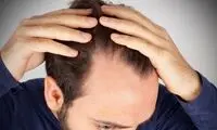 4 نکته خوراکی درباره ریزش موی سر

