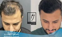 کاشت مو، ابرو و ریش؛ بهترین روش ترمیم موهای از دست رفته