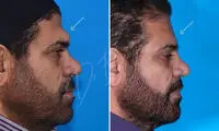همه چیز درباره عمل جراحی پیشانی ناندرتال؛ کاربرد، هزینه و روش‌ها