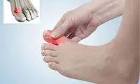 هنگام پیچ خوردن انگشت شست چکار کنیم؟