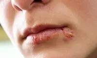 تاول‌های لب؛ از دلایل تا درمان
