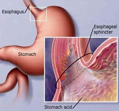 چرا ترش می کنیم؟