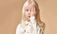 آلبینیسم یا زالی؛ علائم، علل، عوارض و انواع آن