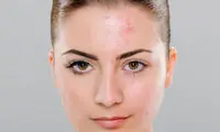 چرا با کاهش دما دچار آکنه می‌شویم؟