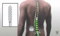 بیمار فلج نخاعی مجددا راه رفت