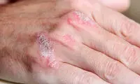 نشانه هایی که از سرطان پوست خبر می دهد