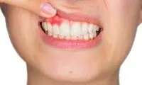 مراقب این بیماری شایع لثه باشید