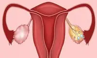 تنبلی تخمدان، علایم و راه‌های مقابله