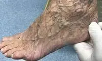 روشی جدید برای درمان واریس
