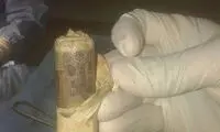 عکس: کشف 1000 پوند در شکم یک بیمار