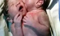 به دنیا آمدن نوزادی دو سر و دارای سه دست در کشور هند