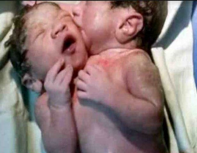 به دنیا آمدن نوزادی دو سر و دارای سه دست در کشور هند