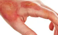 در مواجهه با فرد دچار سوختگی چه کار کنیم؟
