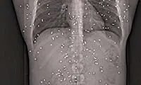 مردی با 150 گلوله در بدن زندگی می کند!