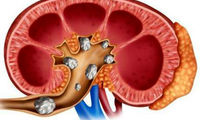 راهکار‌های خانگی برای دفع سنگ کلیه