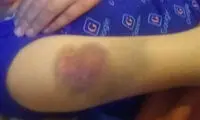 ‌تنبیه دانش‌آموز پایه سوم ابتدایی توسط معلم
