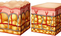 روش‌های از بین بردن و پیشگیری از سلولیت