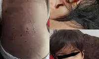 کودک‌آزارى وحشتناک توسط نامادری در ارومیه