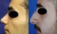 جراحی بینی مردان