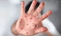 آبله میمونی چه علائمی دارد؟