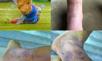 پای ورم کرده مهاجم شیلی +عکس