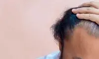 اختلالاتی که موجب ریزش مو می‌شوند