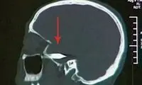خروج گلوله از سر، پس از 23 سال